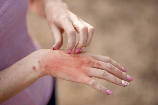 Afbeelding van stress jeuk bultjes