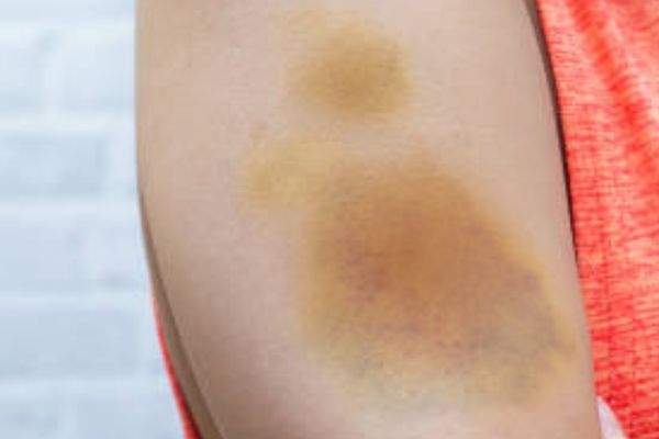 Geel en bruine blauwe plekken