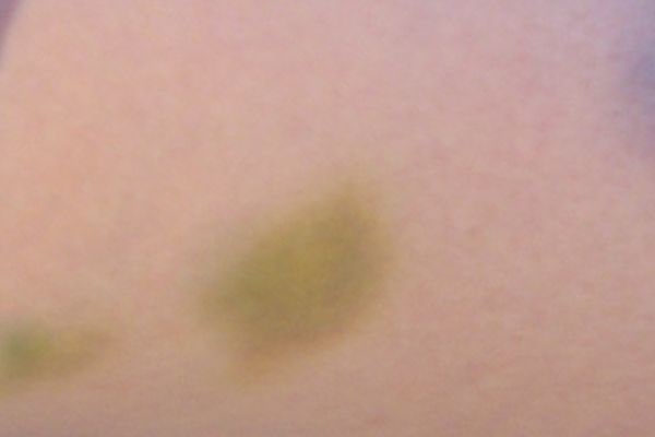 Groene blauwe plekken