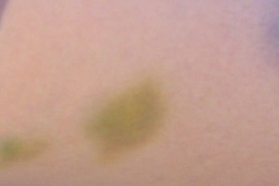 Groene blauwe plekken