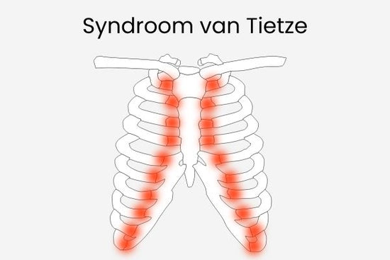 Inforgraphic syndroom van Tietze