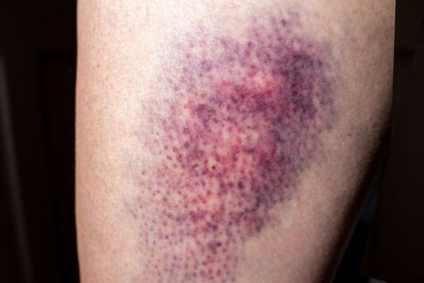 Rood en roze blauwe plek