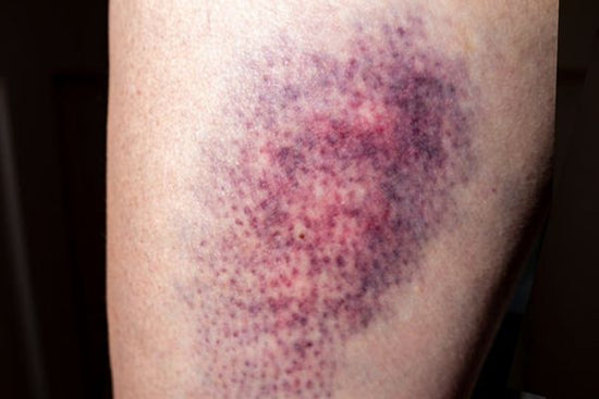 Rood en roze blauwe plek