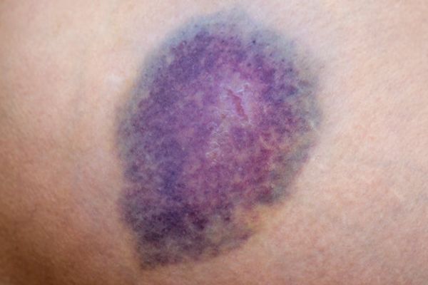 Leeftijdsbepaling van blauwe plekken