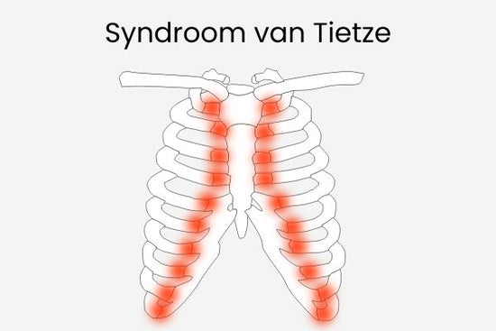 Inforgraphic syndroom van Tietze